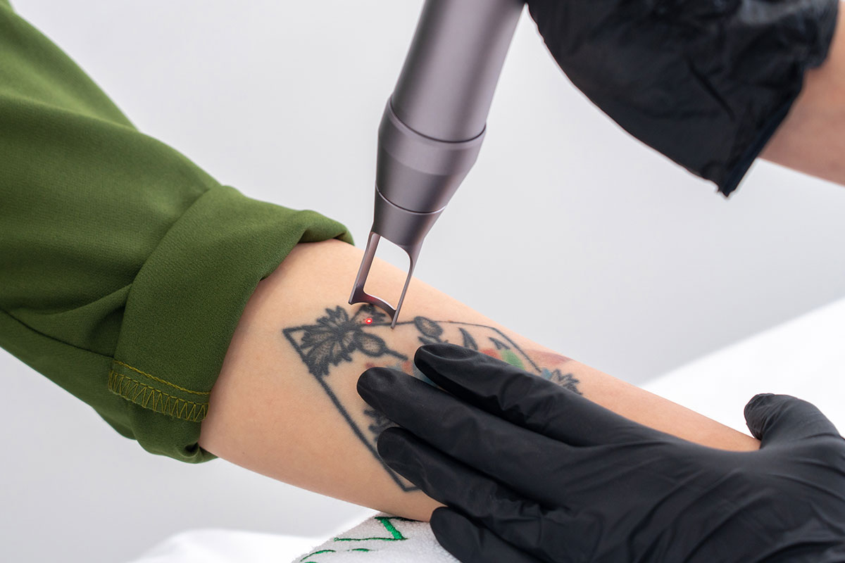 Laser Tattoo Removal in Albertville, AL